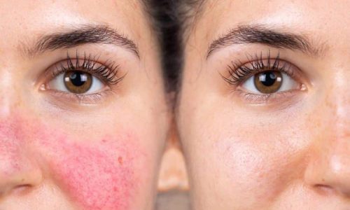 Gentle Care for Redness: Skincare for Rosacea Explained