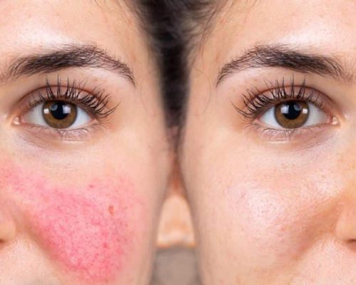 Gentle Care for Redness: Skincare for Rosacea Explained